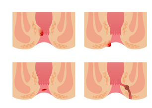 阴茎延长帮助修复因性问题导致的冷战或疏远